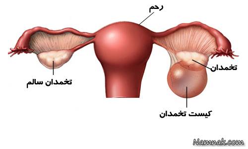 کیست تخمدان از علائم تا جراحی و درمان