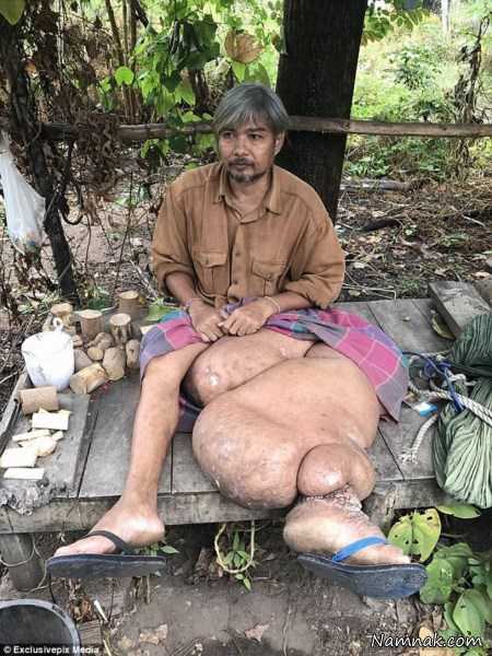 لنف ادم پا , عکسهای مرد تایلندی با پای 26 کیلویی
