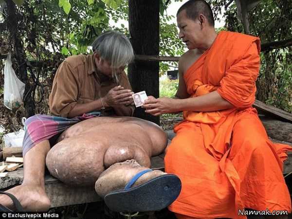 لنف ادم پا , عکسهای مرد تایلندی با پای 26 کیلویی