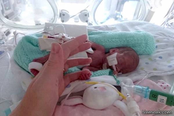نوزاد نارس , زنده ماندن نوزاد 23 هفته ای زیر تیغ جراحی