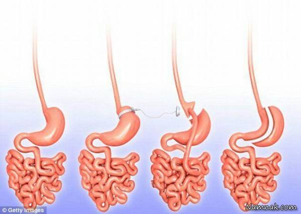 عوارض کاهش وزن با عمل بای پس معده