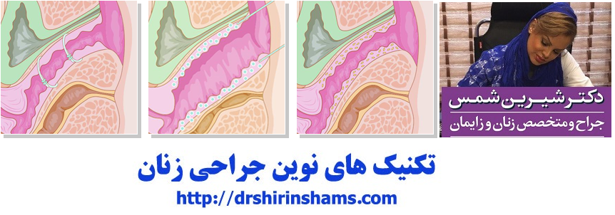 جراحی زیبایی واژن