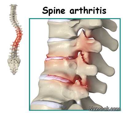 علائم و درمان روماتیسم ستون فقرات