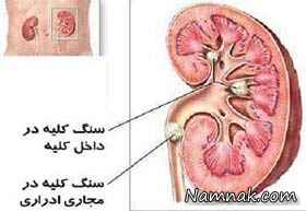 سنگ کلیه و روش های درمان آن