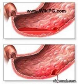 علائم خونریزی معده چیست؟