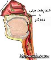 علایم خلط گلو و راههای درمان آن