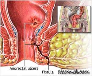 آبسه مقعدی | علائم و راههای آبسه مقعدی و فیستول با جراحی لیزر و بدون جراحی