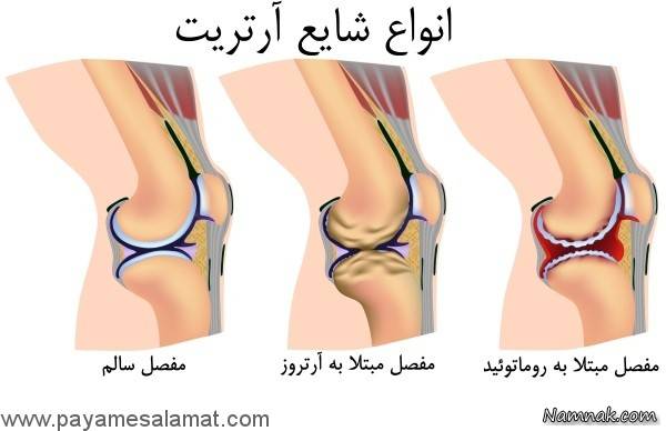 آرتریت روماتوئید درد بعد از بیدار شدن از خواب