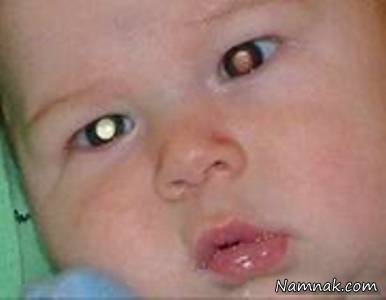عوامل خطر رتینوپاتی چشم در نوزادان را بشناسید