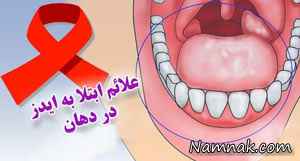 نشانه های بیماری ایدز در دهان چیست؟ + عکس