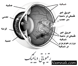 رتینوپاتی در نوزادان نارس باعث کوری می شود