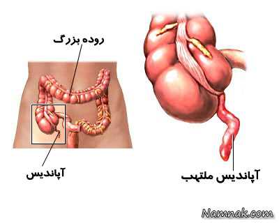 علائم تشخیص درد آپاندیس