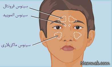 علائم سینوزیت و درمان آن