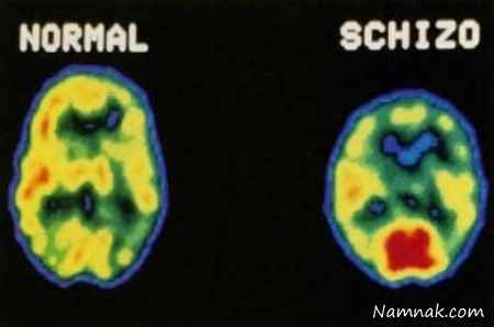 علائم اسکیزوفرنی چیست؟