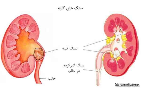 سنگ کلیه و راههای درمان سنگ کلیه