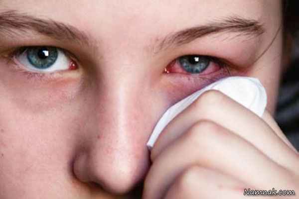 درمان طبیعی عفونت چشم