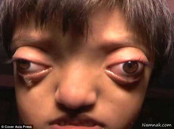 بیماری عجیب | بیماری عجیب چشم قورباغه ای کودک هندی