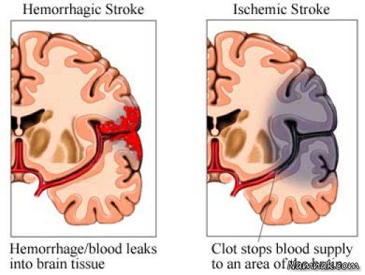 سکته مغزی | علل ، نشانه و تمام راههای درمان “سکته مغزی”