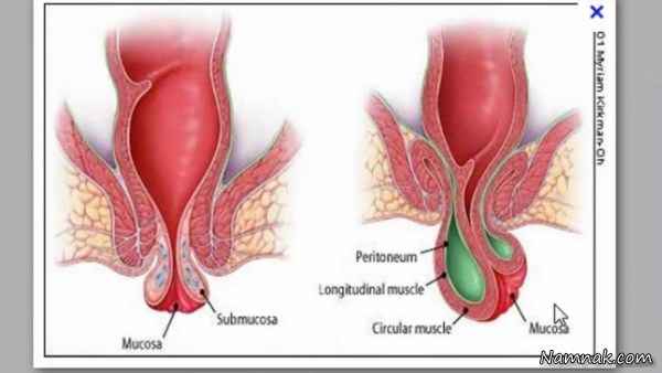 بواسیر | علائم و راههای درمان طبیعی “بواسیر”