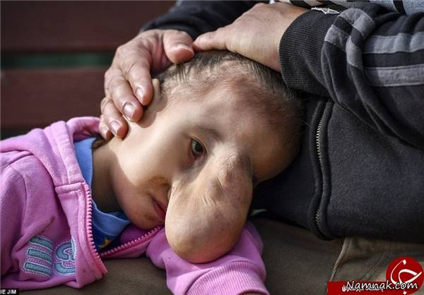 تصاویر دردناک از رشد توده بزرگ روی صورت دختر بچه