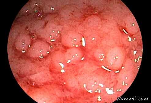 کولیت روده | درمان و علل بیماری کوریت روده