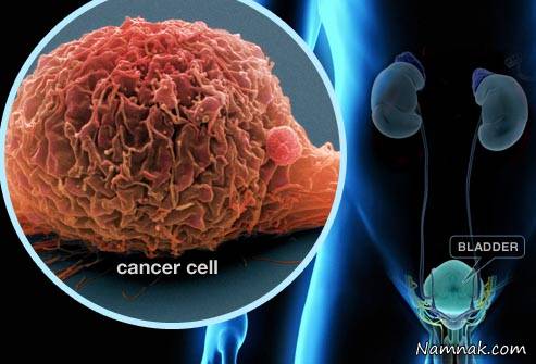سرطان مثانه کشنده ترین سرطان دستگاه ادراری