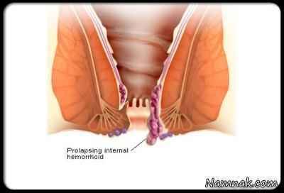 درمان بواسیر و علت بواسیر