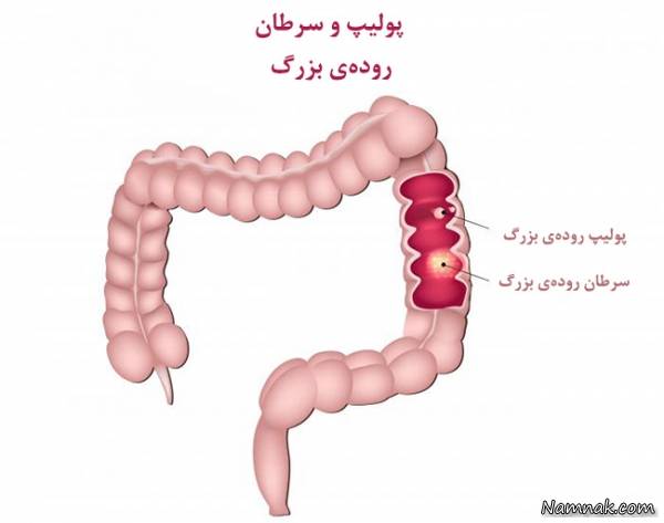 تشخیص سرطان روده بزرگ و درمان آن