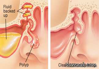 از خطرات پولیپ بینی چه میدانید؟