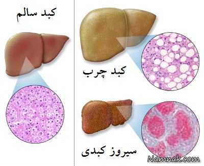 پیشگیری از بیماری کبد چرب