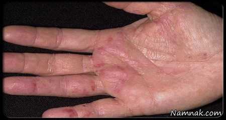 بیماری سرطان دست و شناسایی علایم آن