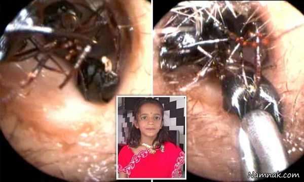 زایشگاه مورچه ها در گوش دختر 12 ساله هندی! + تصاویر