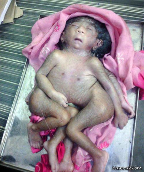 تولد نوزاد عجیب الخلقه با 4 پا در هند + تصاویر