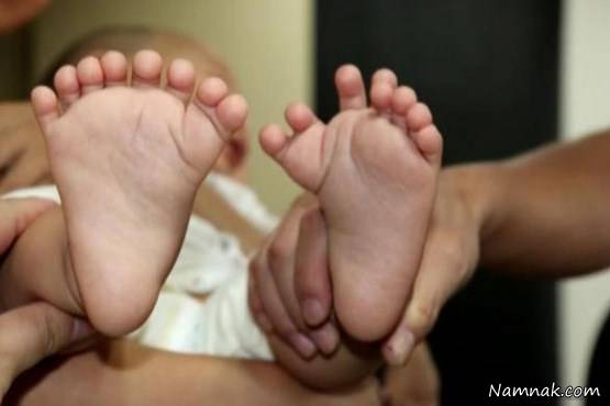 تولد نوزاد 31 انگشتی در چین + تصاویر
