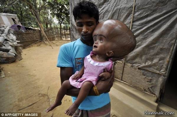 تولد نوزاد بنگلادشی با سری به وزن 9 کیلوگرم! + تصاویر