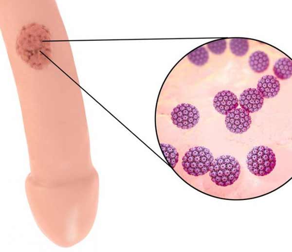 	ویروس پاپیلومای انسانی (HPV): علت زگیل تناسلی | وب 