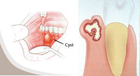 کیست دندان چیست؟ + علت علائم و راه های درمان