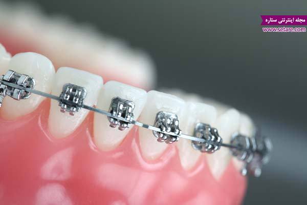 	ارتودنسی چیست؟ + مراحل، بهترین زمان و هزینه ارتودنسی دندان