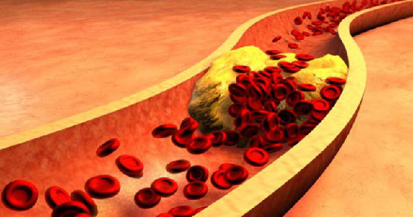 قرص رزوواستاتین؛ موثر در کاهش چربی خون | وب 