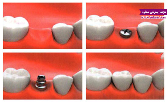 	مراحل ایمپلنت دندان (کاشت دندان) چگونه است؟! | وب 