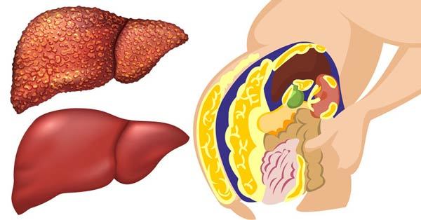 پاکسازی کبد چرب؛ چگونه سلامت کبد را بازگردانیم؟ | وب 