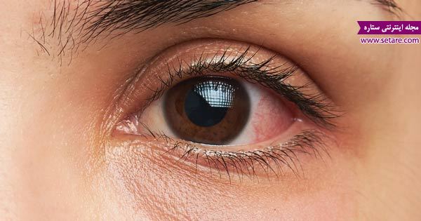 	علت و علائم عفونت چشم چیست؟ + راه های درمان عفونت چشم