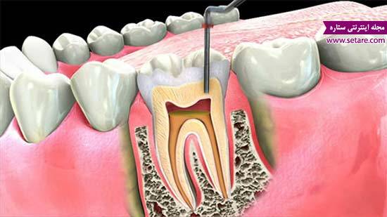 	درمان ریشه دندان یا روت کانال تراپی چیست؟