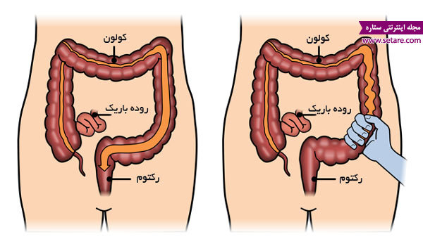 	علائم سندرم روده تحریک پذیر (IBS) چیست؟ | وب 