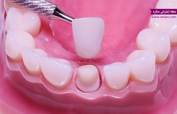 	جلوگیری از پوسیدگی دندان و درمان پوسیدگی دندان | وب 