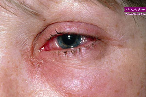 	درمان خانگی آب سیاه چشم (درمان بیماری آب سیاه در طب سنتی) | وب 