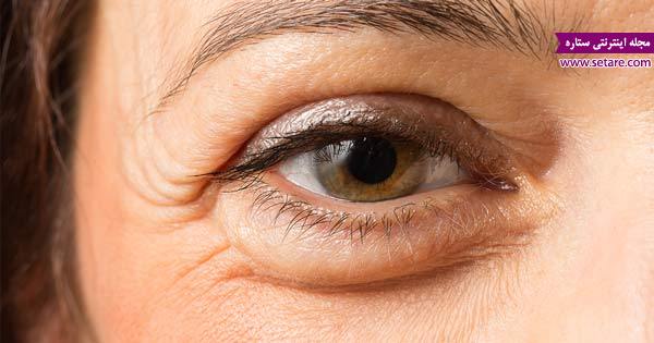 	علت پف زیر چشم چیست؟ + راه های درمان و از بین بردن پف زیر چشم