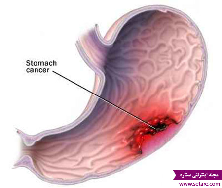 	علائم سرطان معده چیست و چگونه درمان می شود؟ | وب 