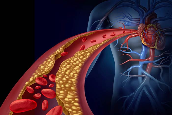 	گرفتگی قلب یا گرفتگی رگ قلب چیست و چگونه درمان می شود؟ | وب 
