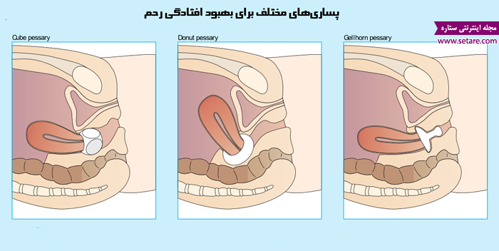 	علائم افتادگی رحم چیست؟ + راه های درمان افتادگی رحم | وب 